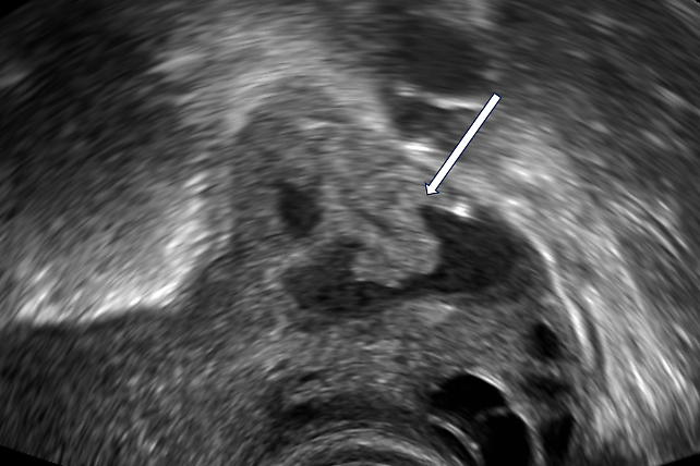 Fallopian Tube Abnormalities on Ultrasound | Article | GLOWM